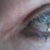 One year later - Outer left eye scar...there was NO NEED to cut that part!