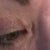One year later - scars are really bad on inner and upper lids