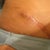close up of high scar side. Pre-revision. Excuse the ripped underwear!! :-)