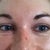 NOW. Smiling. Note multiple wrinkles under eye despite botox treatment.