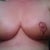 1 Week after surgery