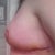 1 Week after Surgery