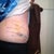 Day 1 post op scar revision and lipo.