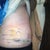 Day 1 post op scar revision and lipo.
