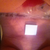 front view sitting- sorry its upside down - 3 days post op