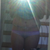 front view standing 2 days post op