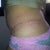 1 Month Post Op