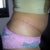1 Month Post Op