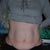 Before Tummy Tuck Frontal shot