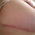 Nasty keloid scars :(