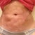 4 months post op 
LUMPY, skin discoloration and some numbness