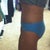 3 months side view--still have some swelling