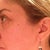 Six month post 4th Fraxel treatment-no makeup