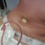 My 24 hr post-op appt. There is my new belly button:)