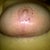 4 wks post op-RIGHTY. Notice the spitting stitches on the nipple. These were removed on Monday. Now the incision can close up completely like the left.