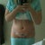 Three days post-op.