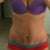About 4-5 months post op:)