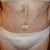 Not a very good photo but gives a hint of what final result will be like ... bit of swelling and bruising but I am very pleased to get rid of pouch and overhang.