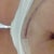 Half glue half stitches... Part of a clinical trial....