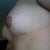 Big scar, and bad location under the muscle.