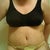 Post Op Day 6 still swollen and feeling bloated!