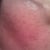 12 HOUR POST TREATMENT - RIGHT SIDE
