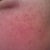 12 HOUR POST-TREATMENT - LEFT SIDE