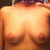 Before, day of pre-op