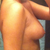 Before, side view, day of pre-op