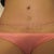 2months-only nice outcome is scar and BB. scar is very smooth and flat.  used silicone strips for about 1-2weeks and not using any scar treatments now.