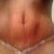 Scar one Week close up...still swollen around the BB