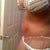 side veiw one week post op