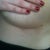 2 1/2 weeks - scar
