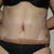 1 Week post-op