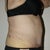 1 Week post-op