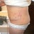 Post op day 9
Left side