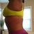 2 month Post Op BBL 18NOV12