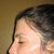 Day 11 - can see the blotchiness and redness