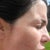 Day 24... look around forehead for "honeycomb" texture... stripes on cheeks.. (Scar from son scratching)