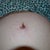 new stretch marks around belly button. 5 wks post