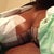 9 days post op :)