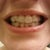 Aligner 10