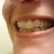 Aligner 10