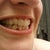 Aligner 10, 1/4 of the way through!