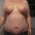 Day 25, close-up of abdominal scar and breast, arms down to show the actual position of the breast.