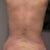 Day 25, my back..you can still see the bruising marks but much better.