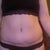 post op day 26, looking better without the adhesive.