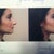 side: shaving the bump and making it less projected
