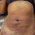 this is day after procedure