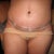 Post Tummy Tuck - Day 12
